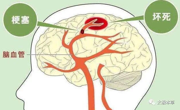 脑梗治疗最新方法概述