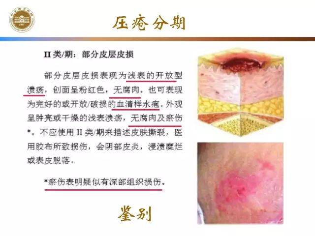 关于压疮的最新分期研究及其在护理实践中的应用（聚焦2017年分析）